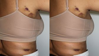 One Wrong Move And The Entire Contour Is Wrong - Cases of liposuction gone wrong