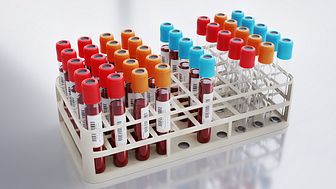Biomarkör i blod förutspår typ 2-diabetes