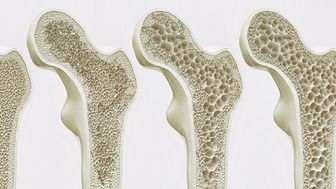 Bewegung und Krafttraining gegen Osteoporose - Ansatz der FPZ/DVGS OsteoporoseTherapie