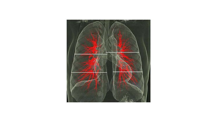 Förekomsten av lungsjukdomen KOL har minskat, men utvecklingen i dödlighet har stått mer eller mindre stilla under de senaste tio åren. 