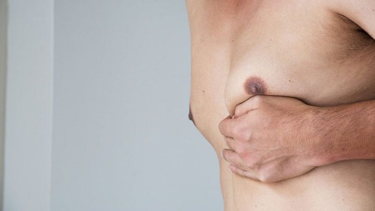 All you need to know about gynecomastia
