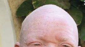 Barn med albinism lever farligt i Tanzania