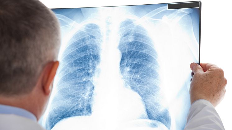 I Sverige beräknas att cirka 500 människor varje år får lungcancer som en följd av radon i luft