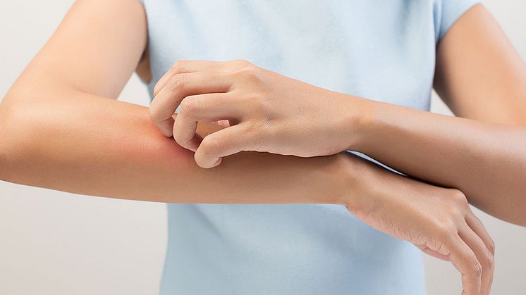 Första fas III-studien med Rinvoq (upadacitinib) som monoterapi vid atopisk dermatit uppvisar förbättrad hudläkning och minskad klåda jämfört med placebo