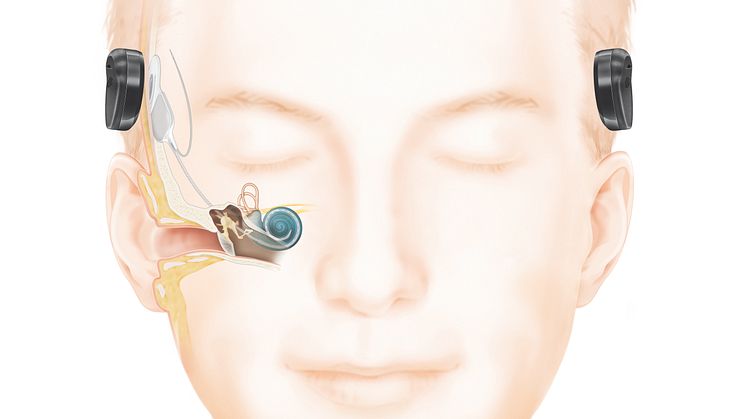 Wie das Hören mit einem Cochlea-Implantat (frei vom Ohr) funktioniert