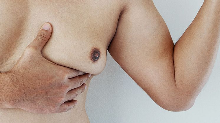 There’s just as much fact as fiction circulating on the internet when it comes to what causes man boobs, or gynecomastia, if you’d prefer the more learned term. Amaris B. Clinic’s Dr Ivan Puah explains what’s true, and what’s not.