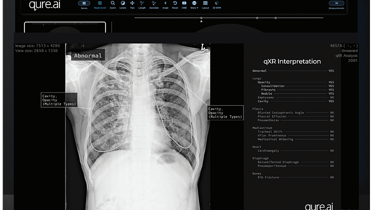 Qure.ai's CE-certified chest X-ray solution, qXR, will help identify which cases are clear of clinically relevant findings, allowing radiologists to detect them even before they open the case. 