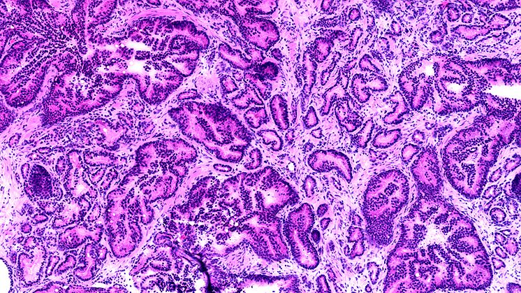 A microscopic image of cancerous prostate tissue. (Image: KTH Royal Institute of Technology/SciLifeLab