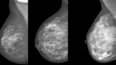 Bild från Karolinska Institutet. Från vänster ett bröst med låg mammografisk täthet, till höger ett bröst med mycket hög täthet. 