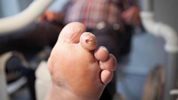 Et diabetisk fodsår kan se uskyldigt ud, men det kan resultere i amputation og er derfor et kritisk fodproblem. Foto: Mie Hampen