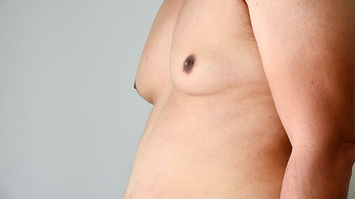 If you have gynecomastia — the medical term for “man boobs” — you’re far from alone. In fact, an estimated 30% of men experience gynecomastia in their lifetime, according to a 2014 study.