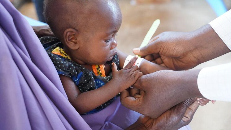 Fawzia, 9 månader, får behandling mot undernäring i Somalia