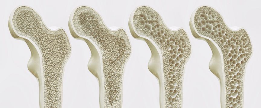 Stadien der Osteoporose
