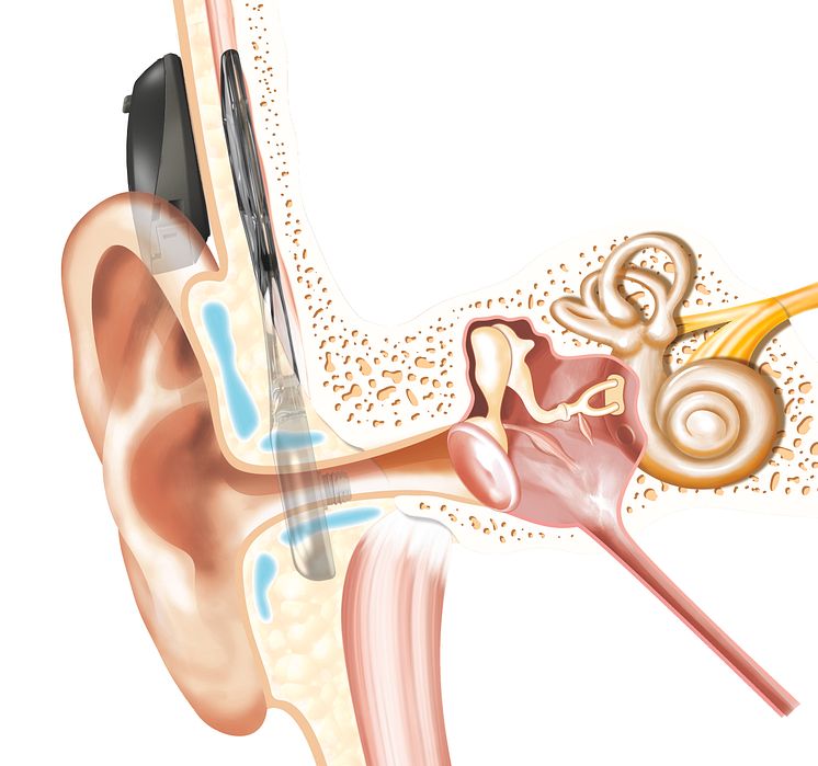 Schaubild - Cochlear™ Osia® System