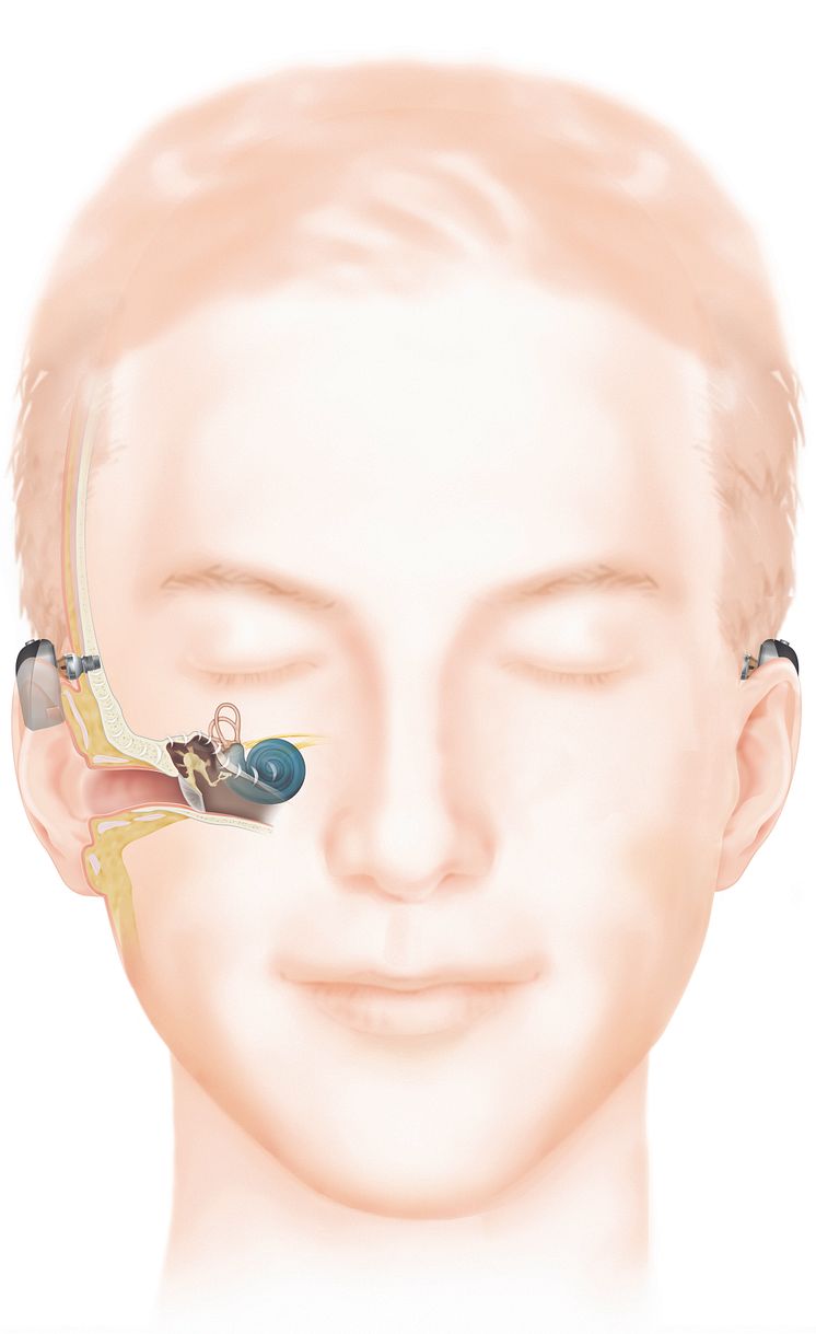 Wie das Hören mit einem Baha Knochenleitungsimplantat (Connect) funktioniert