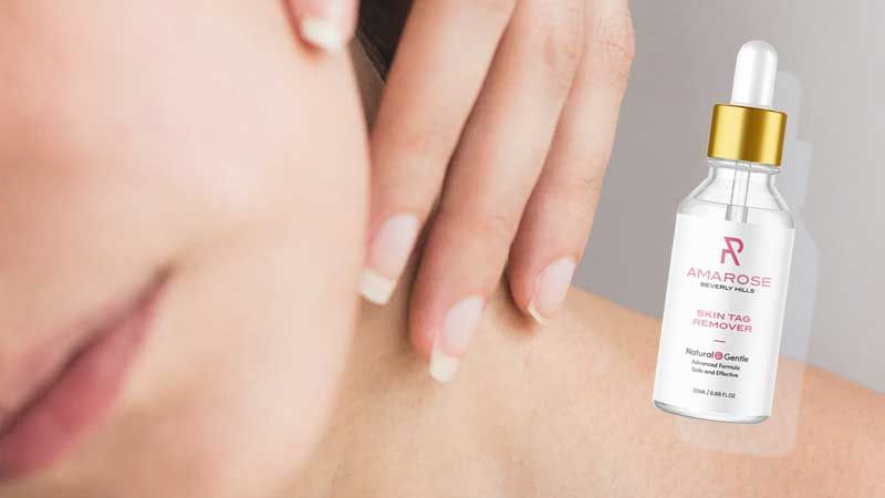 Amarose effect on treating skin tags